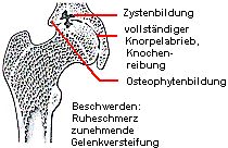 arthrosestat3.jpg