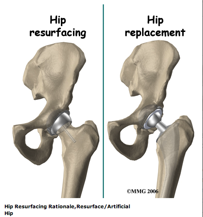 hip_resurfacing_arthrthroplasty.png